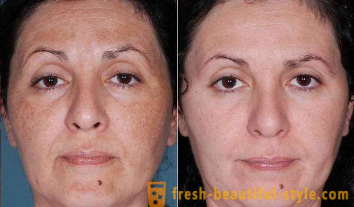Peeling de ácido para o rosto: comentários, fotos antes e depois