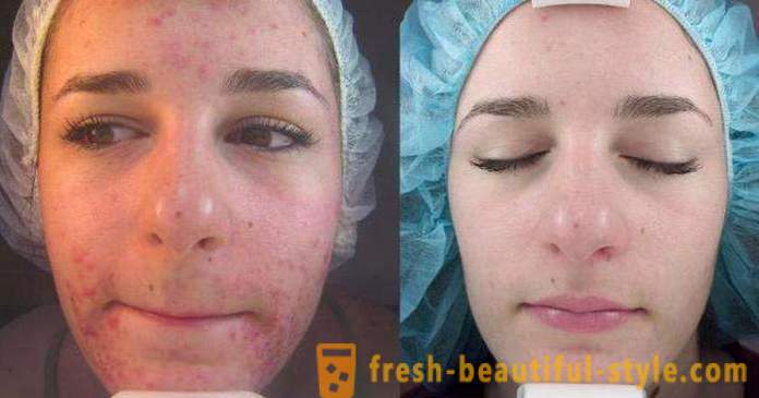 Peeling de ácido para o rosto: comentários, fotos antes e depois