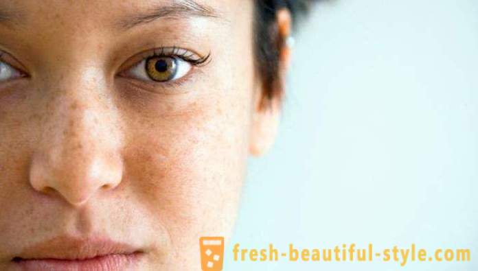 Manchas marrons no rosto: as causas e tratamentos. manchas castanhas