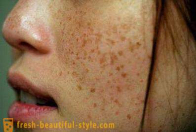 Manchas marrons no rosto: as causas e tratamentos. manchas castanhas