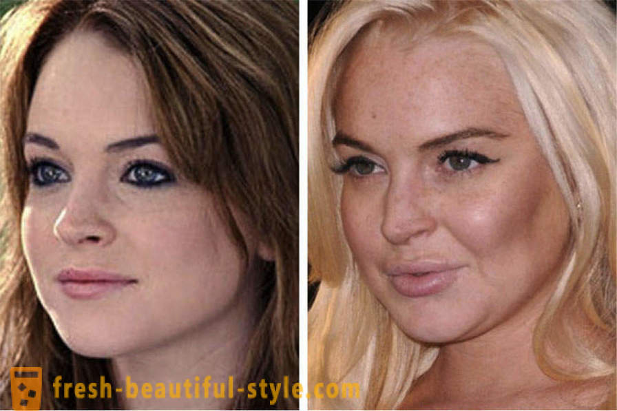 15 celebridades, terminou mal com Botox