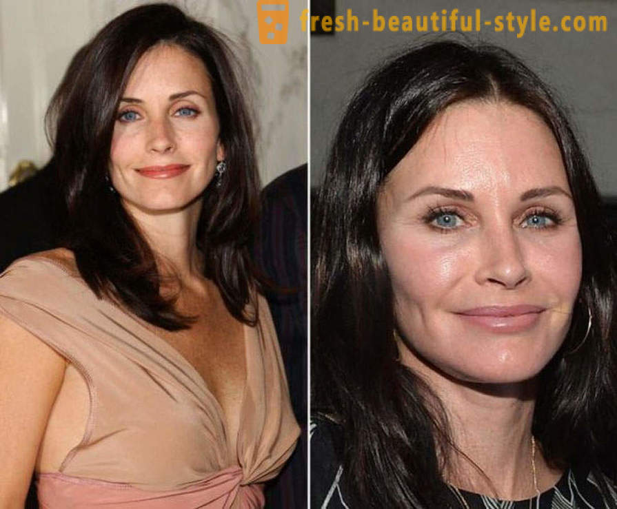 15 celebridades, terminou mal com Botox