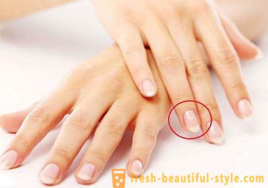 Manchas brancas nas unhas dos dedos: as causas e tratamento