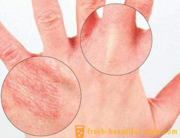 A pele seca das mãos: causas. Muito pele seca, o que fazer?