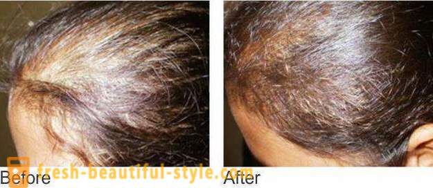 Mesoterapia para o cabelo: Ferramentas da composição e contra-indicações