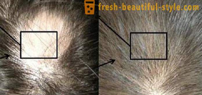 Mesoterapia para o cabelo: Ferramentas da composição e contra-indicações