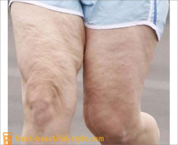 Como se livrar da celulite nas pernas? Exercícios para as pernas de celulite