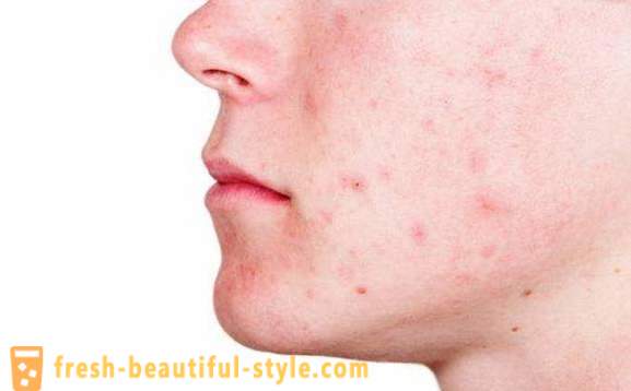 Se livrar da acne e vestígios deles. Como se livrar da acne em diferentes áreas da pele