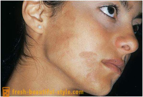 Cuidar da sua beleza e juventude: provoca a pigmentação na face