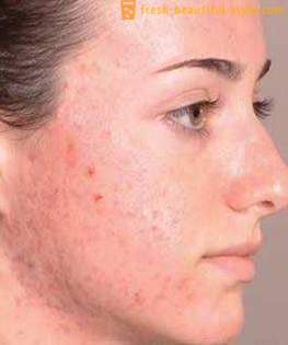 Como se livrar de traços depois de acne e restaurar a pele bela vista?
