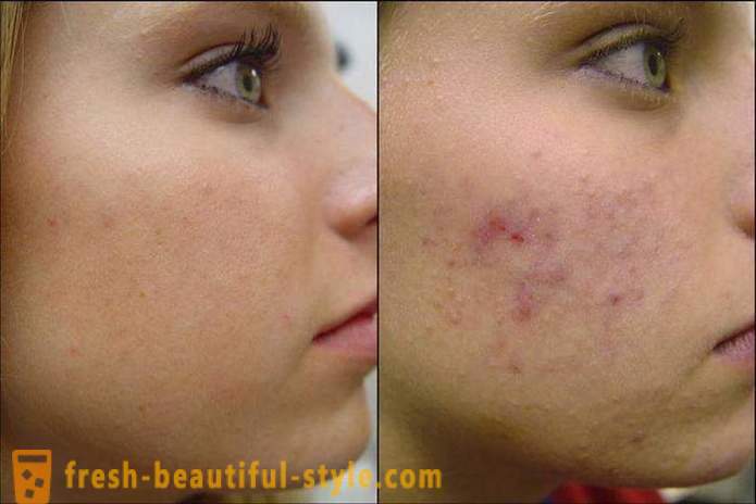 Como limpar o rosto da acne para que eles não mais voltou